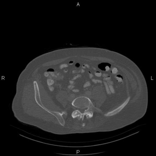 Non Hodgkin lymphoma in a patient with ankylosing spondylitis (Radiopaedia 84323-99624 Axial bone window 50).jpg