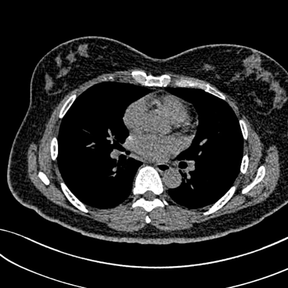 Normal CT chest- adult female (Radiopaedia 52522-58428 Axial non-contrast 69).jpg