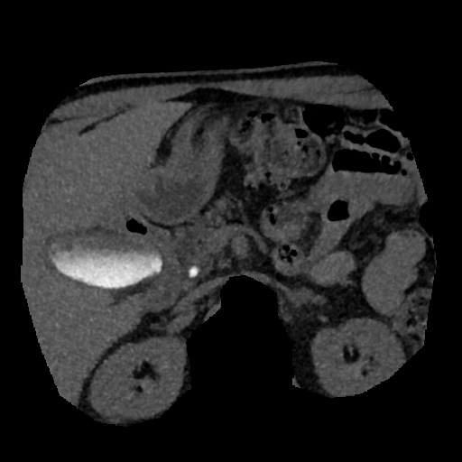 File:Normal CT intravenous cholangiogram (Radiopaedia 38199-40208 Axial IVC (MIP) 36).png