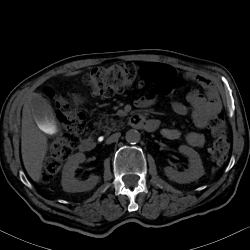File:Normal CT intravenous cholangiogram (Radiopaedia 38199-40208 Axial IVC 47).png