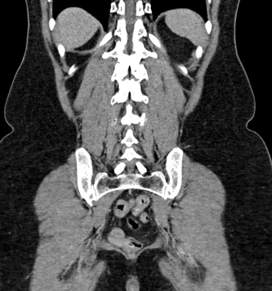 Normal CT intravenous urogram (Radiopaedia 39444-41759 A 349).jpg