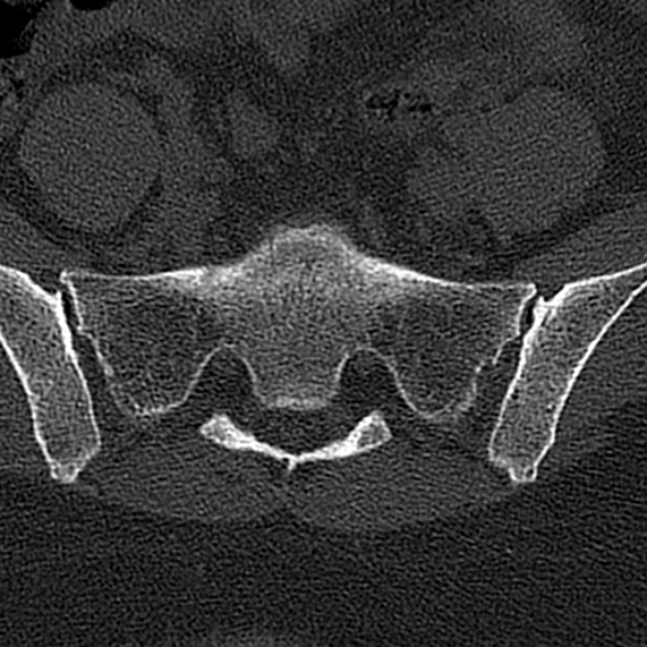 File:Normal CT lumbar spine (Radiopaedia 53981-60118 Axial bone window 70).jpg