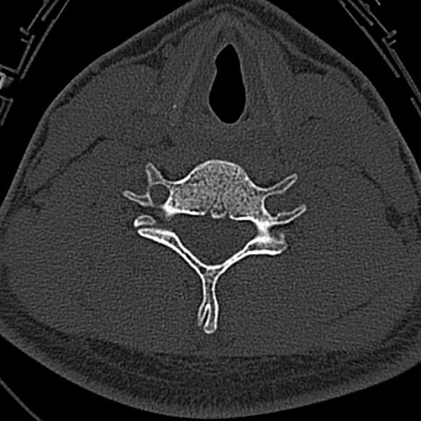 Normal CT of the cervical spine (Radiopaedia 53322-59305 Axial bone window 183).jpg