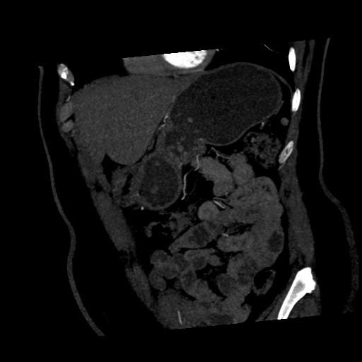 File:Normal CT renal artery angiogram (Radiopaedia 38727-40889 C 1).png