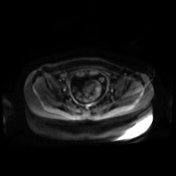 Normal MRI abdomen in pregnancy (Radiopaedia 88001-104541 Axial DWI 48).jpg