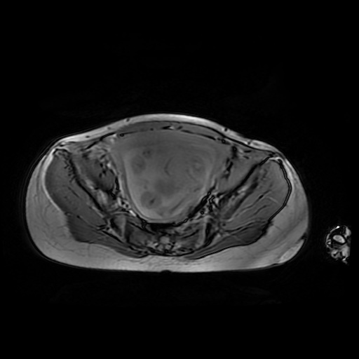 File:Normal MRI abdomen in pregnancy (Radiopaedia 88001-104541 Axial Gradient Echo 45).jpg