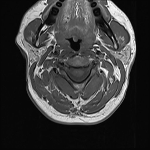 File:Normal MRI cervical spine (infection protocol) (Radiopaedia 53916-60039 Axial 15).png