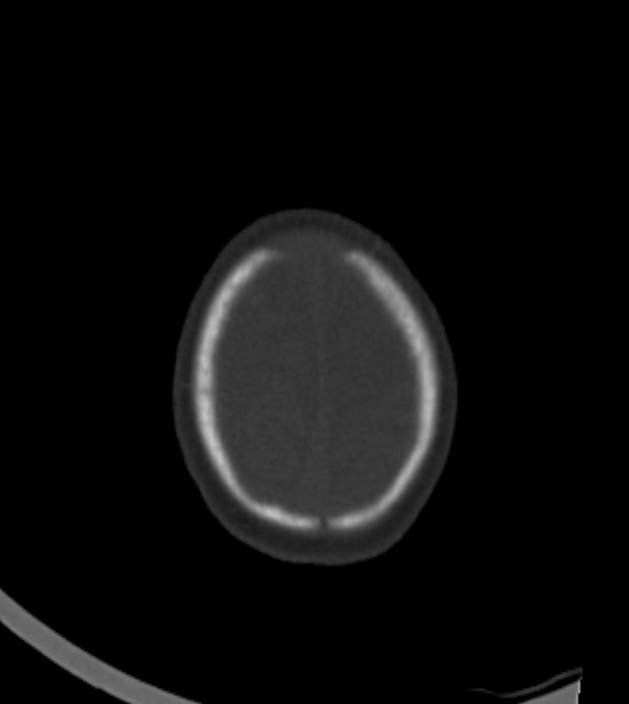 Normal brain CT - 2-month-old (Radiopaedia 53369-59350 Axial bone window 7).jpg