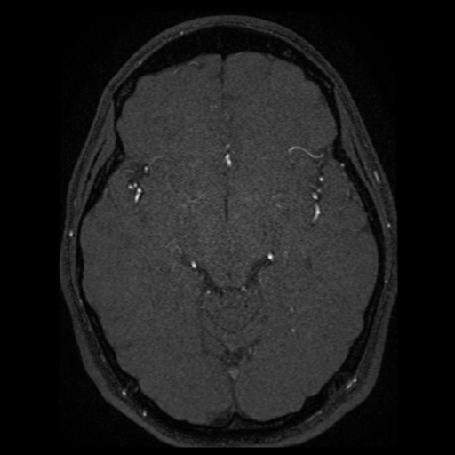 Normal brain MRA (Radiopaedia 41046-43793 Axial MRA 42).png