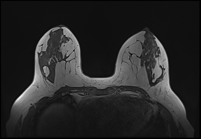 File:Normal breast MRI - dense breasts (Radiopaedia 80454-93850 Axial T1 96).jpg