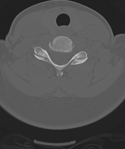 Normal cervical spine MRI (including Dixon) (Radiopaedia 42762-45926 Axial bone window 41).png