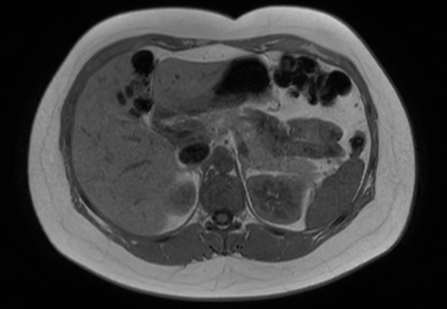 File:Normal liver MRI with Gadolinium (Radiopaedia 58913-66163 Axial T1 in-phase 19).jpg