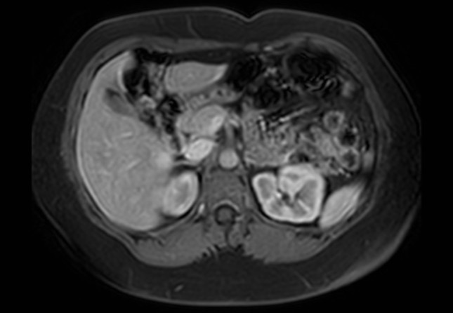 Normal liver MRI with Gadolinium (Radiopaedia 58913-66163 J 36).jpg