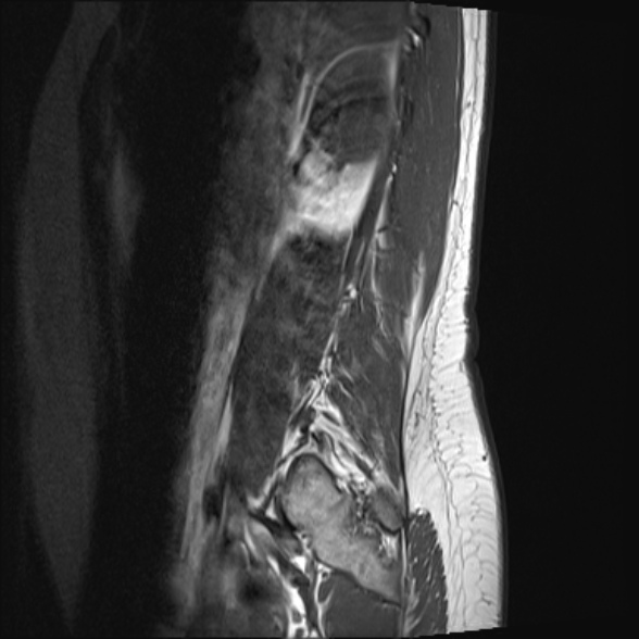 File:Normal lumbar spine MRI- 3 T (Radiopaedia 53280-59250 Sagittal T1 2).jpg