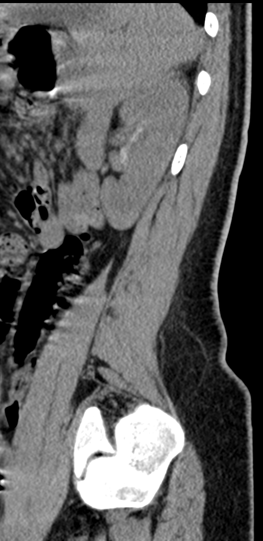 Normal lumbosacral CT (Radiopaedia 37923-39867 E 22).png