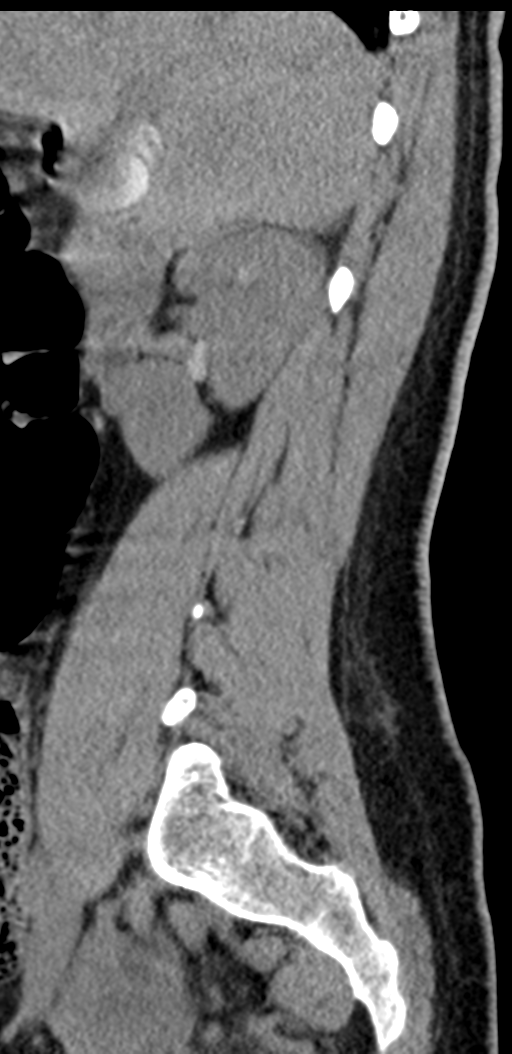 Normal lumbosacral CT (Radiopaedia 37923-39867 E 84).png