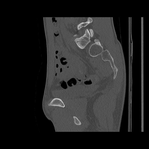 Normal pelvis (Radiopaedia 51473-57238 Sagittal bone window 89).jpg