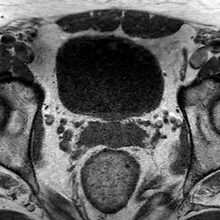 File:Normal prostate (MRI) (Radiopaedia 29986-30535 Axial T1 17).jpg