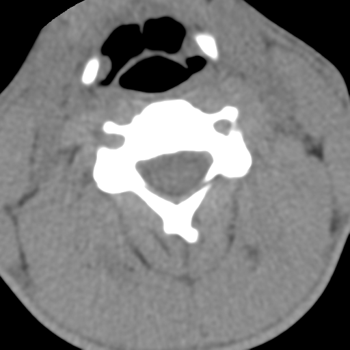 Normal trauma cervical spine (Radiopaedia 41017-43760 Axial non-contrast 29).png