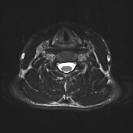 Normal trauma cervical spine (Radiopaedia 41017-43762 D 33).png