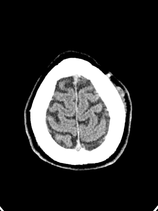 Normal trauma protocol brain and C-spine CT (Radiopaedia 83302-97709 Axial non-contrast 14).jpg