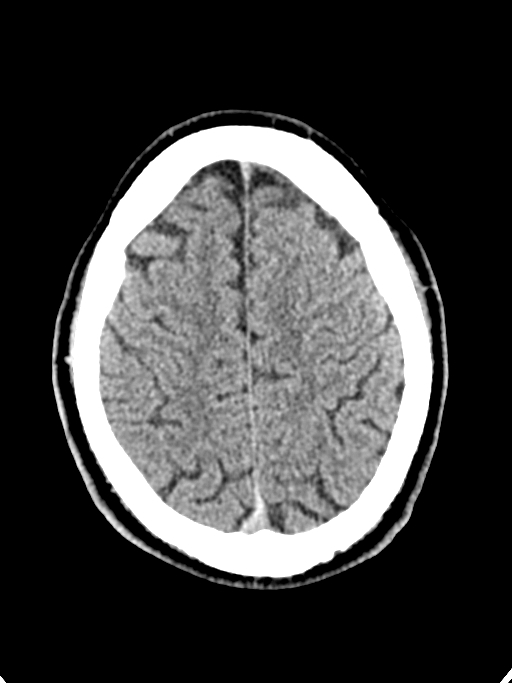 Normal trauma protocol brain and C-spine CT (Radiopaedia 83302-97709 Axial non-contrast 21).jpg