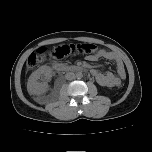 File:Obstructed kidney with perinephric urinoma (Radiopaedia 26889-27066 Axial non-contrast 26).jpg