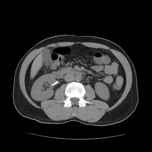 File:Obstructed kidney with perinephric urinoma (Radiopaedia 26889-27067 Axial non-contrast 15).jpg