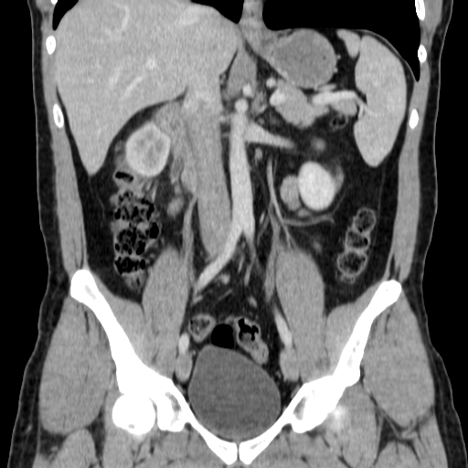 File:Obstructing ureteric calculus (Radiopaedia 18615-18514 C 39).jpg