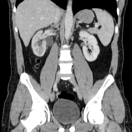 File:Obstructing ureteric calculus (Radiopaedia 18615-18514 C 44).jpg