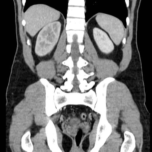 File:Obstructing ureteric calculus (Radiopaedia 18615-18514 C 58).jpg