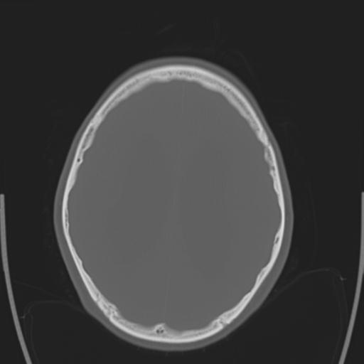 File:Obstructive hydrocephalus (Radiopaedia 30453-31119 Axial bone window 11).jpg