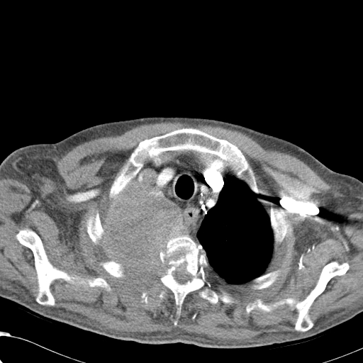 File:Obstructive superior vena cava tumor thrombus (Radiopaedia 28046-28306 A 8).jpg