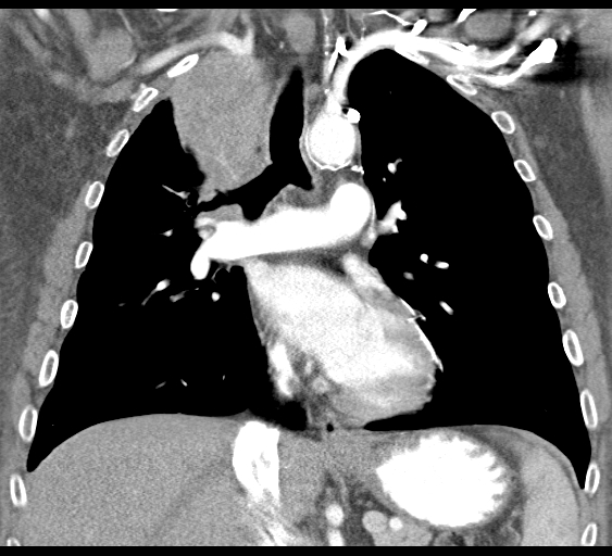 File:Obstructive superior vena cava tumor thrombus (Radiopaedia 28046-28306 B 24).jpg