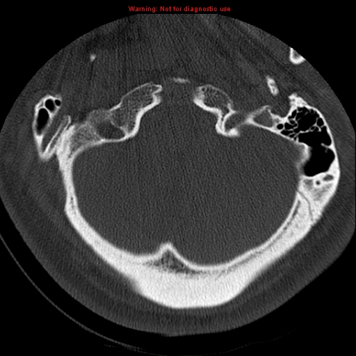 File:Occipital condyle fracture (Radiopaedia 18366-18208 Axial bone window 9).jpg