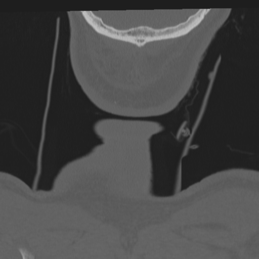 File:Occipital condyle fracture (Radiopaedia 33467-34517 Coronal bone window 82).png