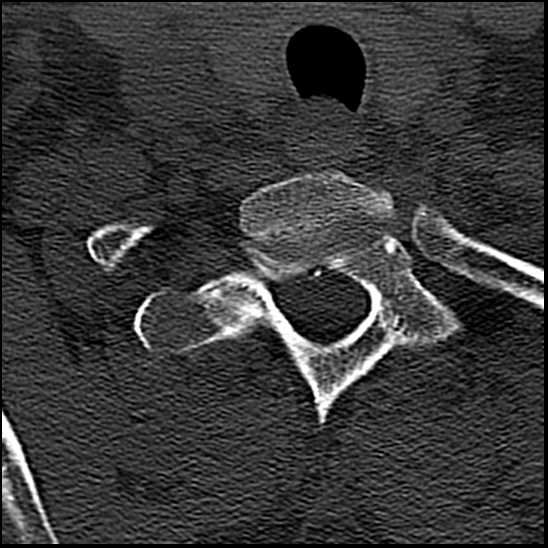 Occipital condyle fracture (type 1) (Radiopaedia 87670-104084 Axial bone window 82).jpg