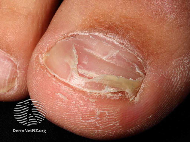 File:Onychomadesis following hand foot and mouth disease (DermNet NZ enteronailped1).jpg