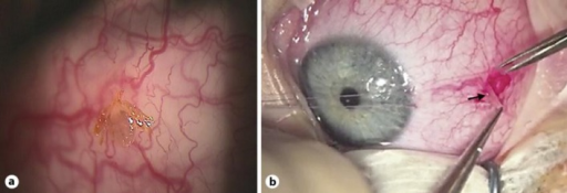 a) Paralysis tick attached to right temporal bulbar conjunctiva b)surgical removal of the larval tick