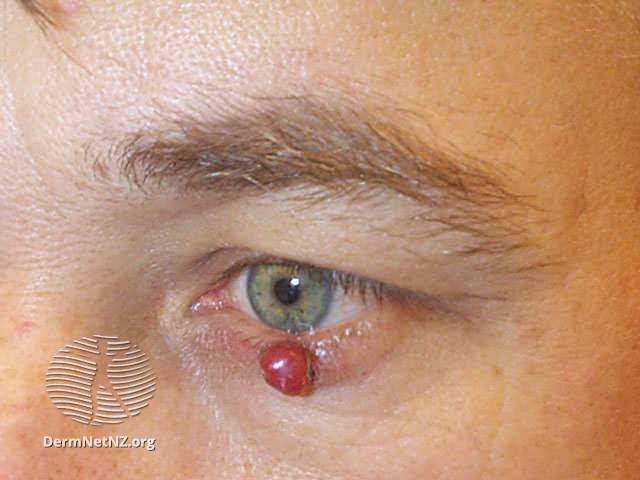 File:Pyogenic granuloma (DermNet NZ doctors-lesions-images-pg2).jpg