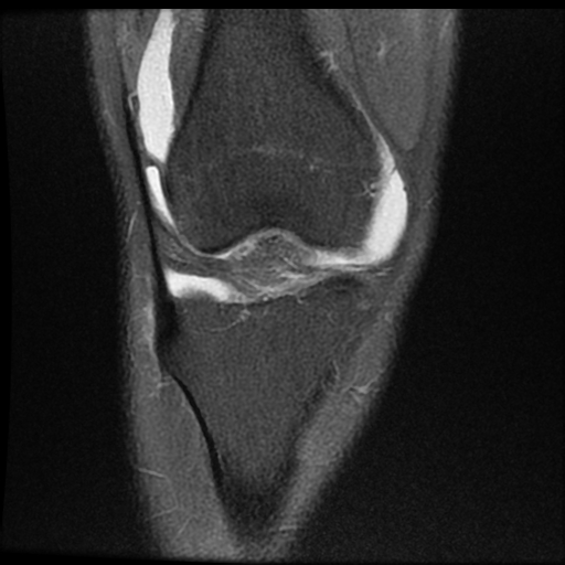 File:ACL acute full thickness tear - deep lateral femoral sulcus sign (Radiopaedia 38594-40740 Coronal PD fat sat 7).jpg