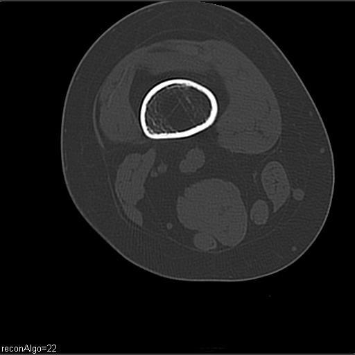 File:ACL avulsion fracture (Radiopaedia 33833-34994 Axial bone window 3).jpg