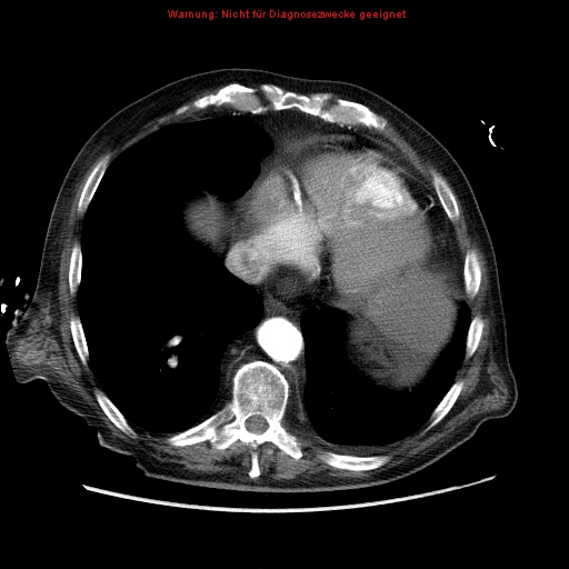 Abdominal aortic aneurysm- extremely large, ruptured (Radiopaedia 19882-19921 Axial C+ arterial phase 5).jpg
