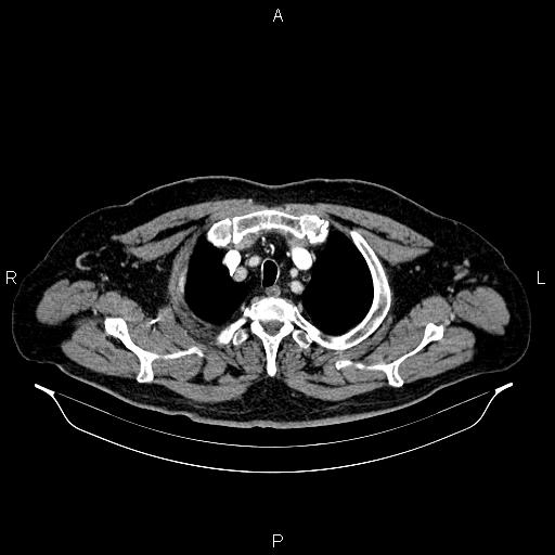 File:Abdominal aortic aneurysm (Radiopaedia 83094-97462 Axial renal cortical phase 12).jpg