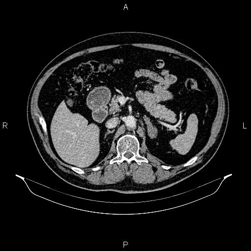 Abdominal aortic aneurysm (Radiopaedia 83094-97462 Axial renal cortical phase 85).jpg
