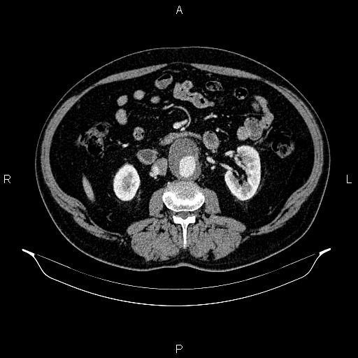 Abdominal aortic aneurysm (Radiopaedia 83094-97462 Axial renal cortical phase 96).jpg