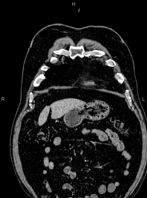 Abdominal aortic aneurysm (Radiopaedia 83094-97462 Coronal renal cortical phase 22).jpg
