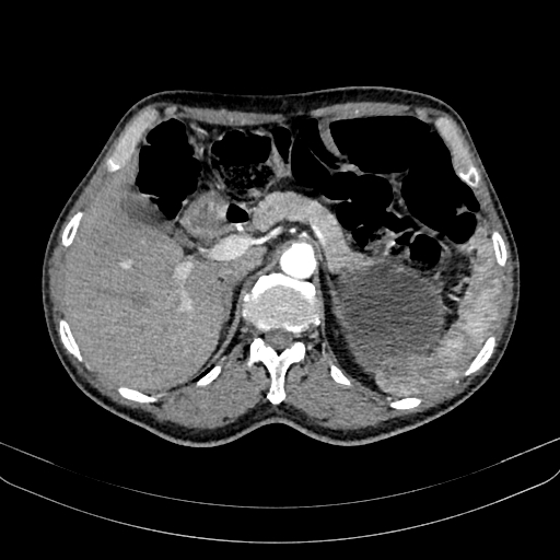 Abdominal aortic aneurysm (Radiopaedia 83581-98689 Axial C+ arterial phase 36).jpg
