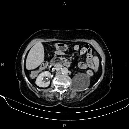 Abdominal aortic aneurysm (Radiopaedia 85063-100606 Axial C+ delayed 40).jpg