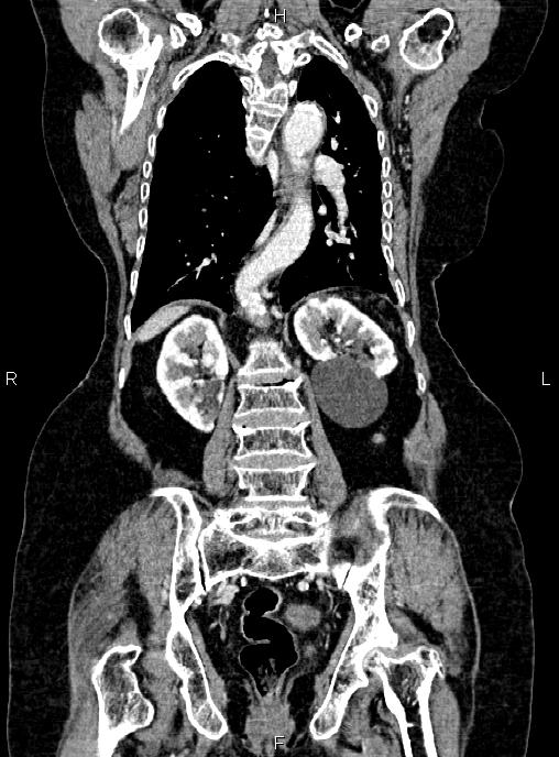 Abdominal aortic aneurysm (Radiopaedia 85063-100606 Coronal C+ arterial phase 40).jpg